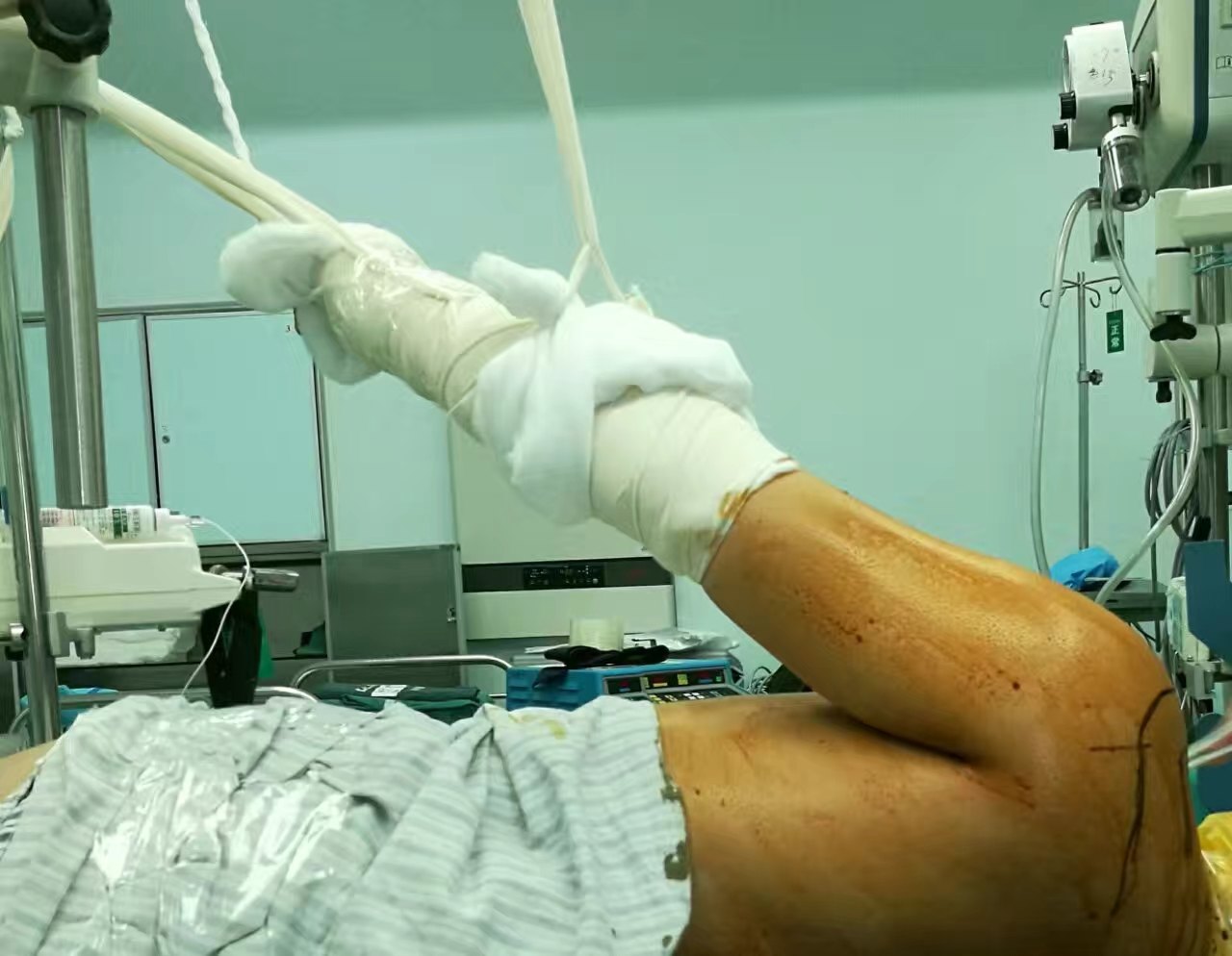 肩关节镜微创治疗病种肩袖损伤肩关节不稳