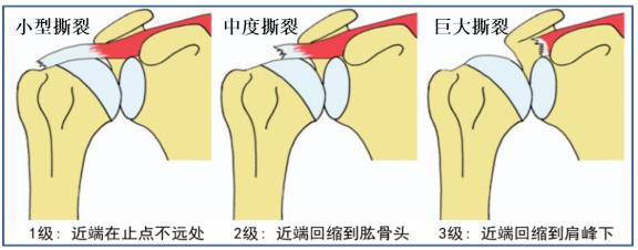 巨大肩袖损伤也能治反肩置换拯救报废肩关节