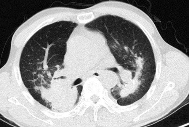 遇到尘肺莫慌张 (原创)