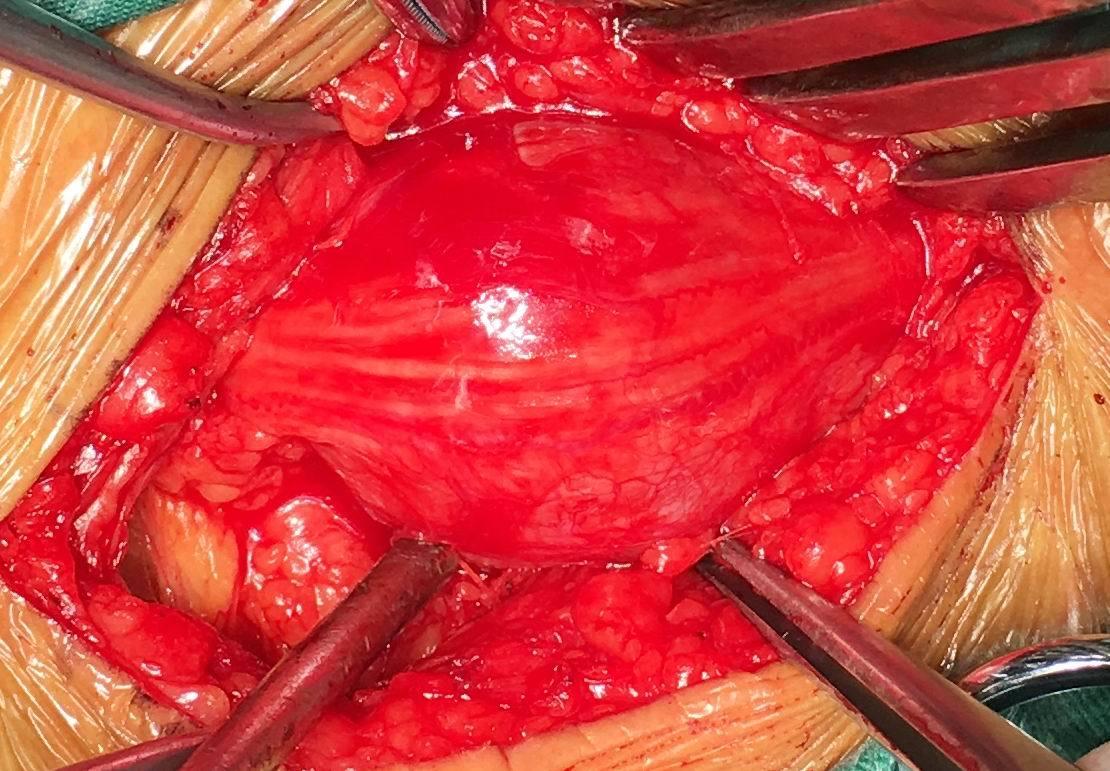 典型病例外周神经鞘瘤