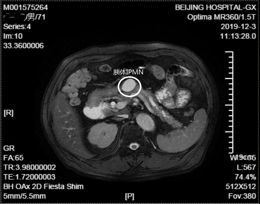 胰管型ipmn图片