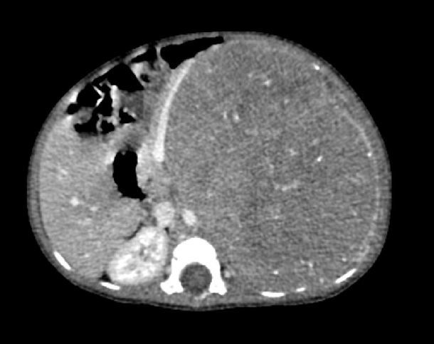 小婴儿后腹膜巨大神经母细胞瘤一期手术完整切除肿瘤