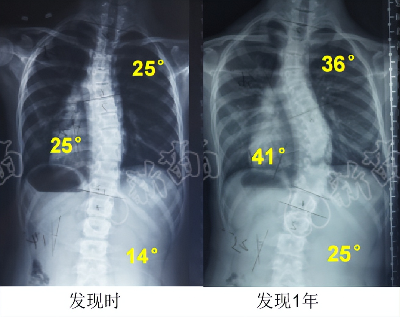 脊柱侧弯10度外观图片