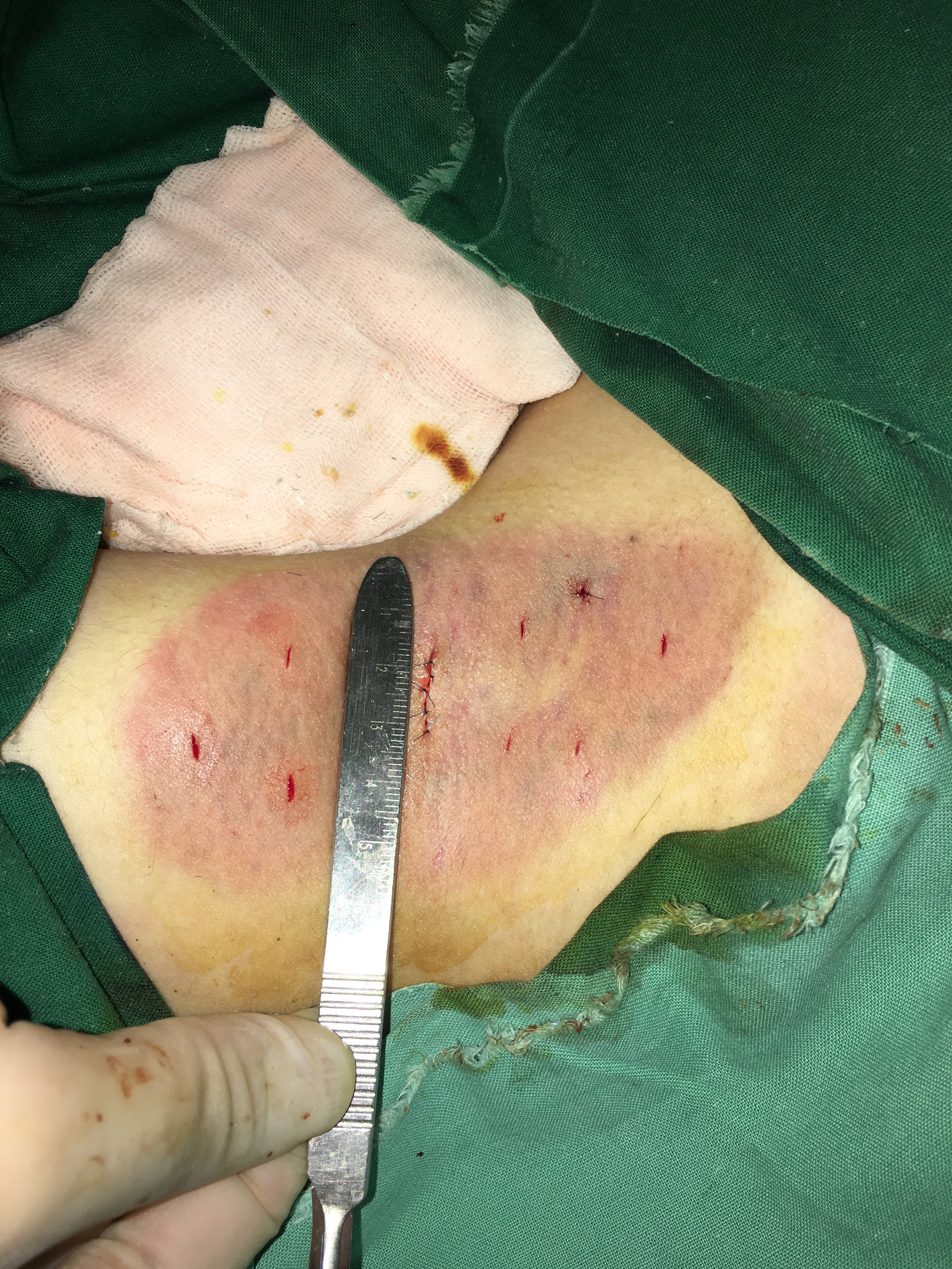 微切口腋臭根除手术不是微创手术