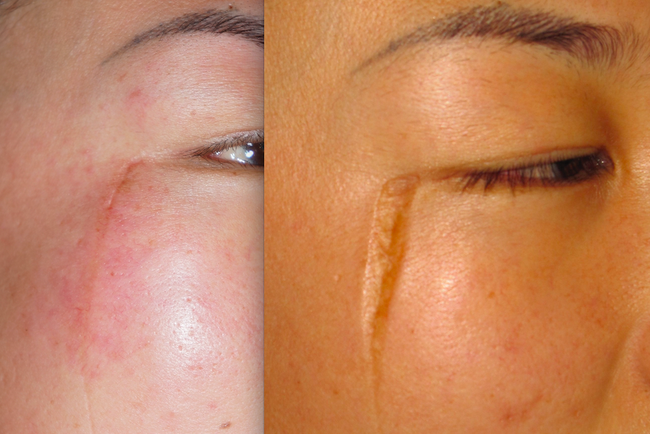 面部精细缝合为什么是整形外科医生的基本功