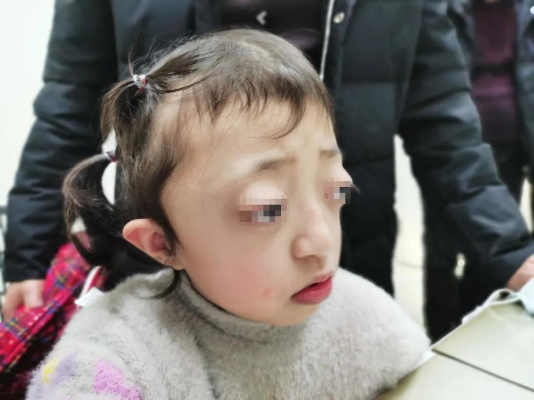 突眼明显的crouzon综合征患儿面诊记录