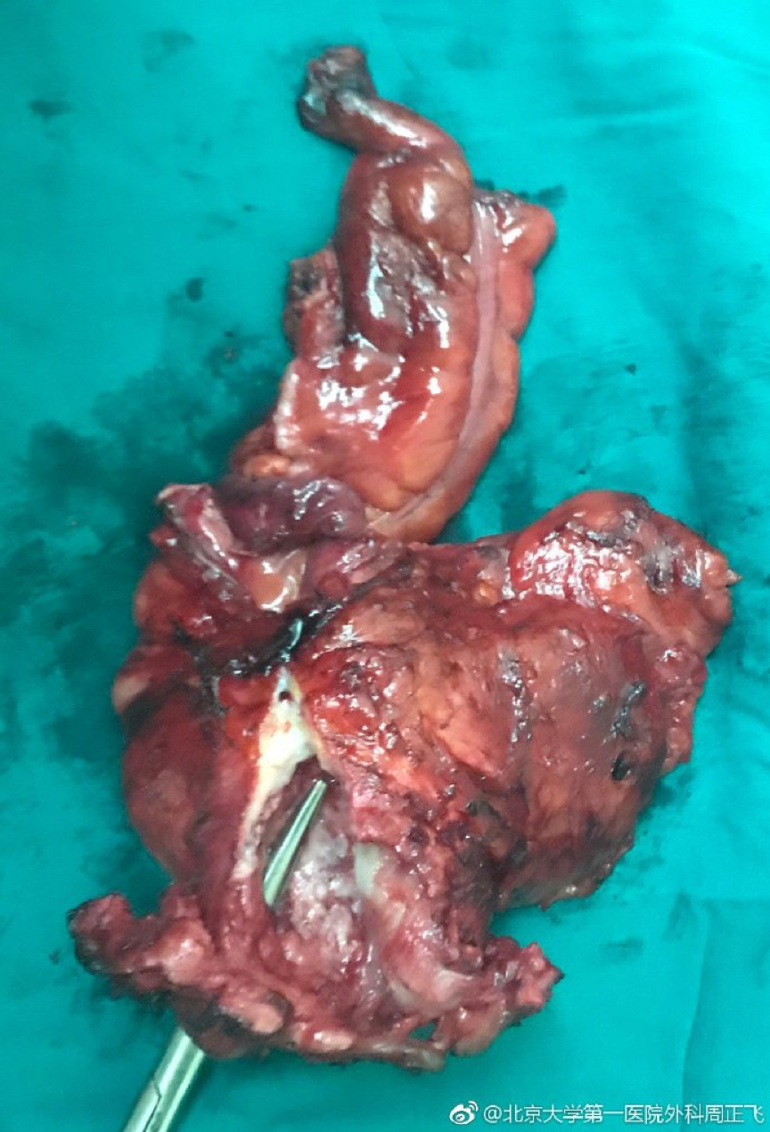 图四为切除标本,可见阴道直肠瘘直径2.