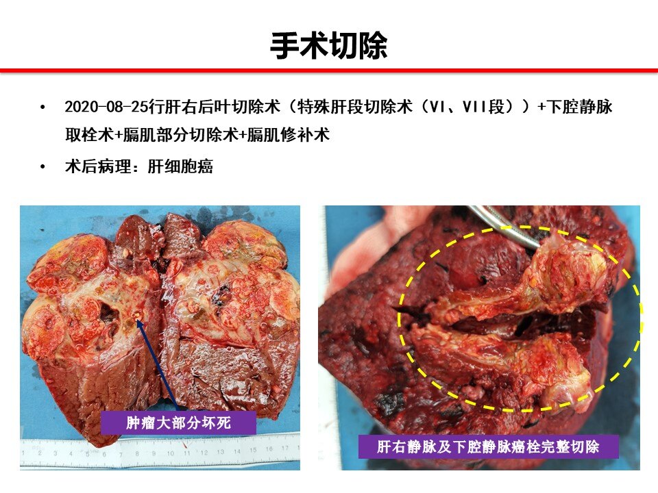 肝癌合并下腔静脉癌栓的患者预后非常差,本病例经过靶向联合免疫治疗