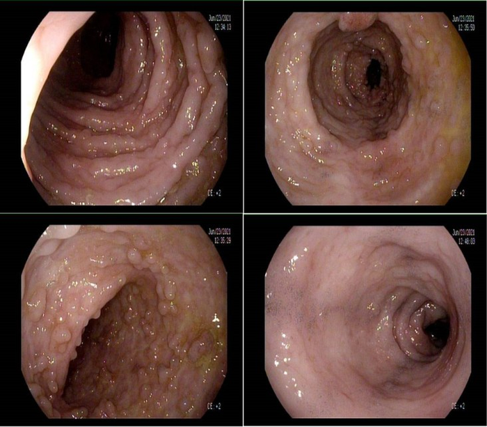 我科经验方青玉散成功"治愈"中重度全结肠型溃疡性结肠炎又一例
