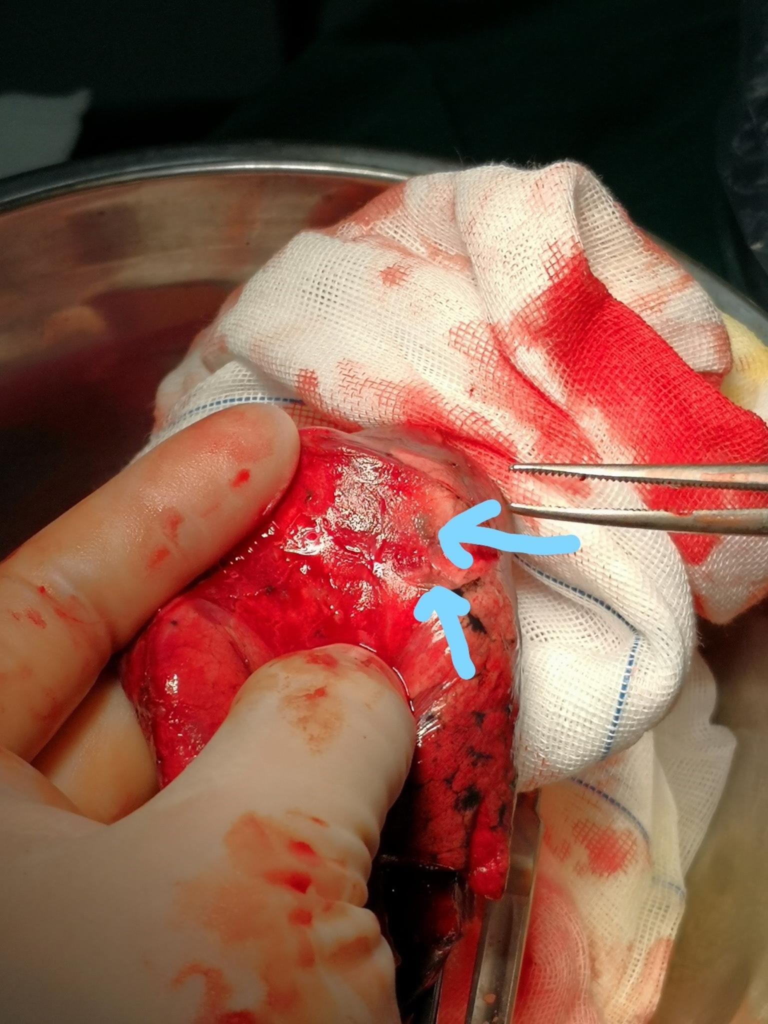 新纪录一次微创肺段手术切除4个磨玻璃结节