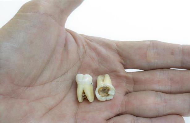 补牙为什么要杀死牙神经?是过度医疗吗?-微医