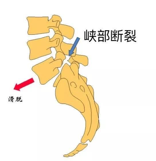 腰椎椎弓峡部解剖图图片