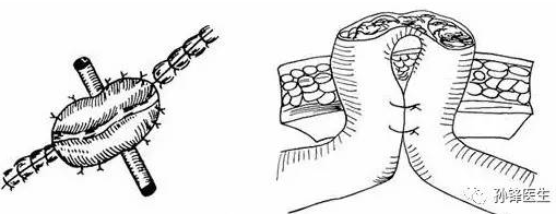 "袢式"肠造口示意图"袢式"肠造口具有以下三种功能:缓解由于原发或