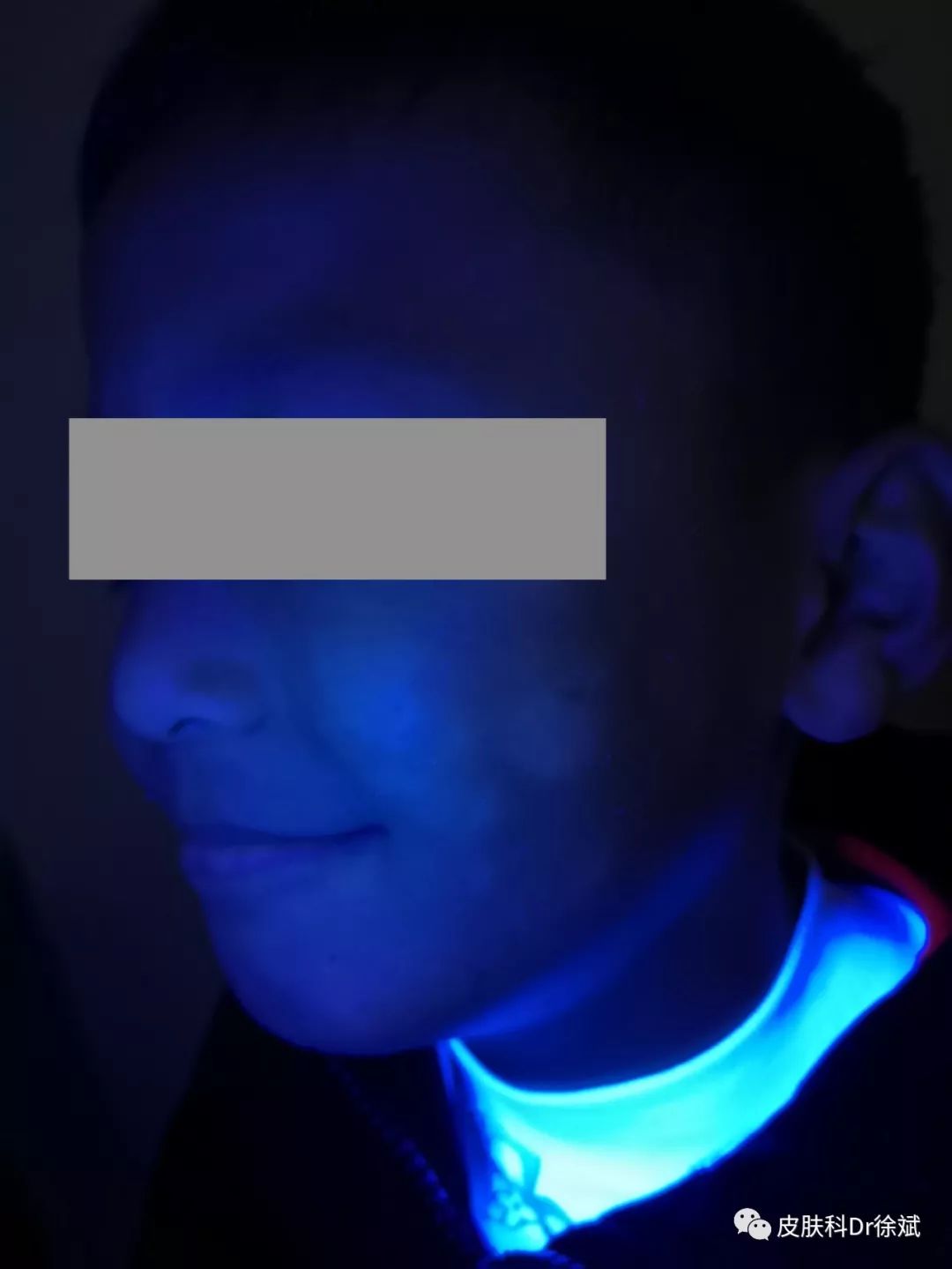 儿童面部白斑怎么办别慌可能和白癜风没有半毛钱关系