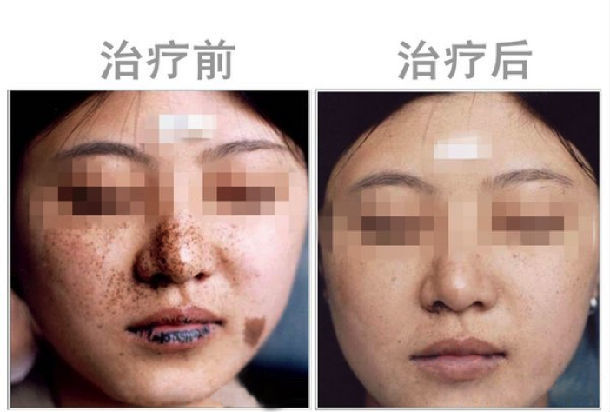 口周黑子病口唇黑斑