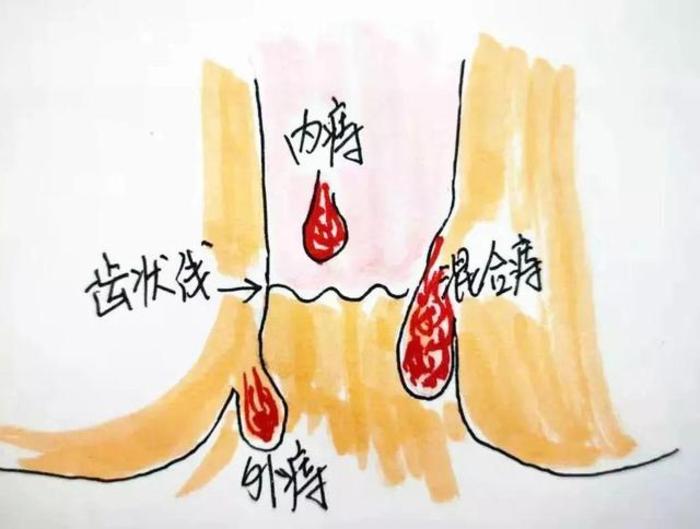 下面的叫外痔,会疼但一般不出血,常常表现为肛门口的小肉球或皮赘.