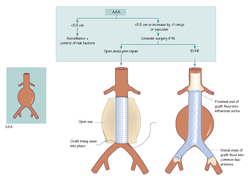 aortic aneurysm repair, evar)