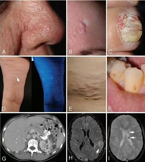 结节性硬化症(tsc)的疾病类型和症状,中医是如何治疗结节性硬化的