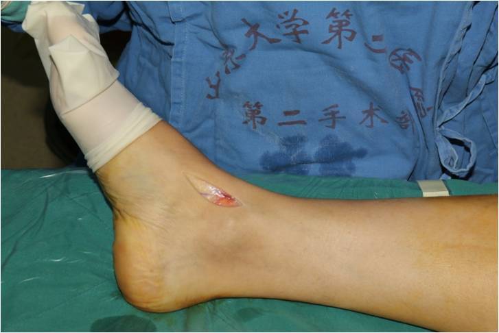 术前磁共振显示距骨囊肿新手术入路手术病例一:传统手术方法(内踝截骨