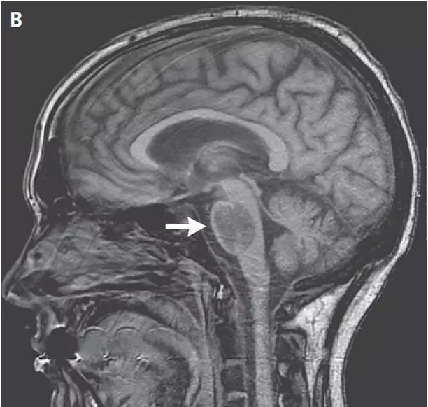 脑桥中央髓鞘溶解症