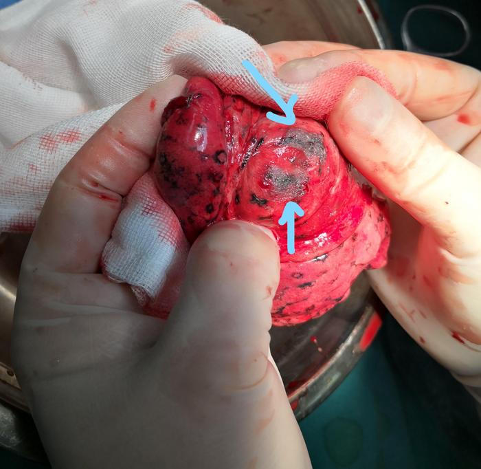 磨玻璃结节故事5因为中叶结节住院却无意中发现右下肺恶性磨玻璃结节