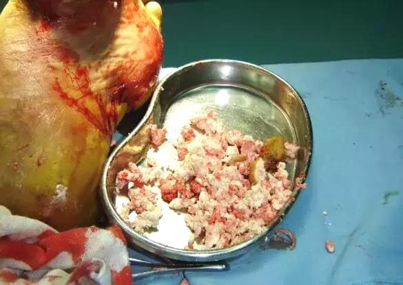 罕见37岁男子全身长满痛风石竟然是因为做了这件事