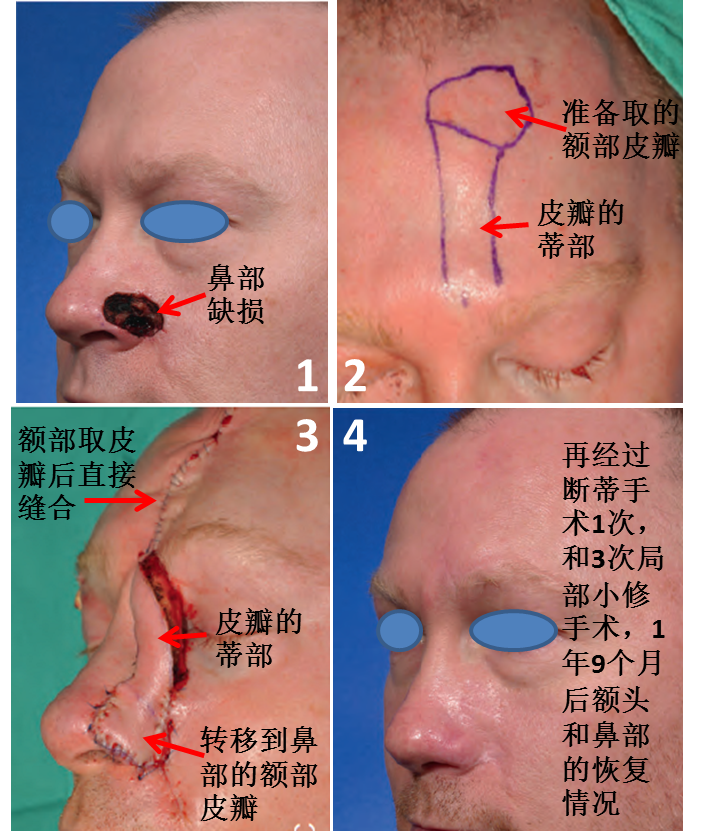 罗说黑痣修复的方法--切除缝合,植皮,皮瓣还是扩张器?