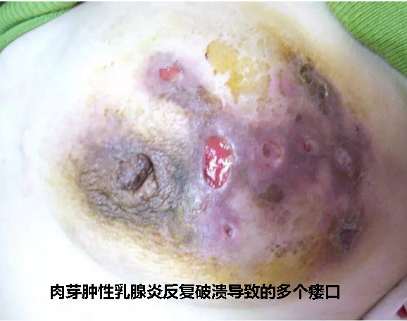 浆细胞性乳腺炎照片图片