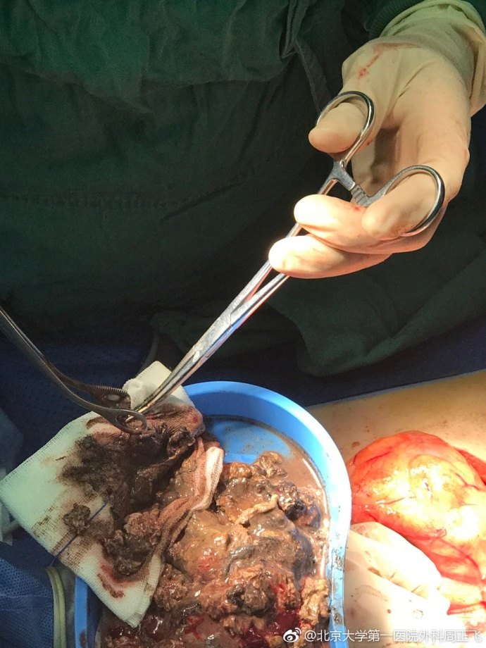 急性重症胰腺炎感染坏死性胰腺炎胰腺脓肿的手术救治