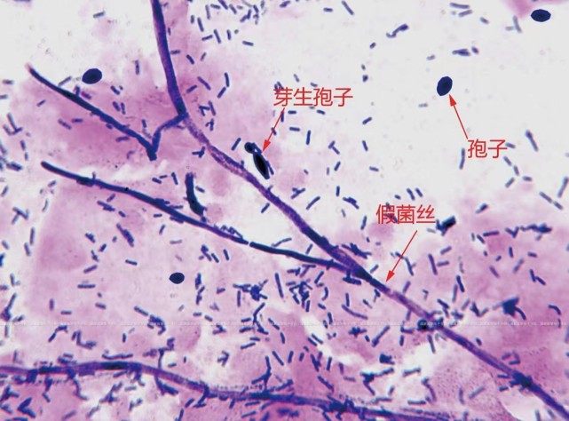 【手把手教你看懂检查报告】白带常规