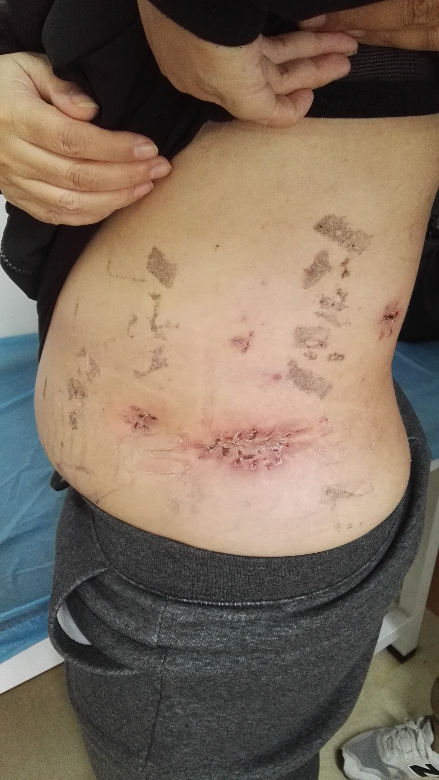 巨大的肾错构瘤哪些可以微创手术保留肾脏