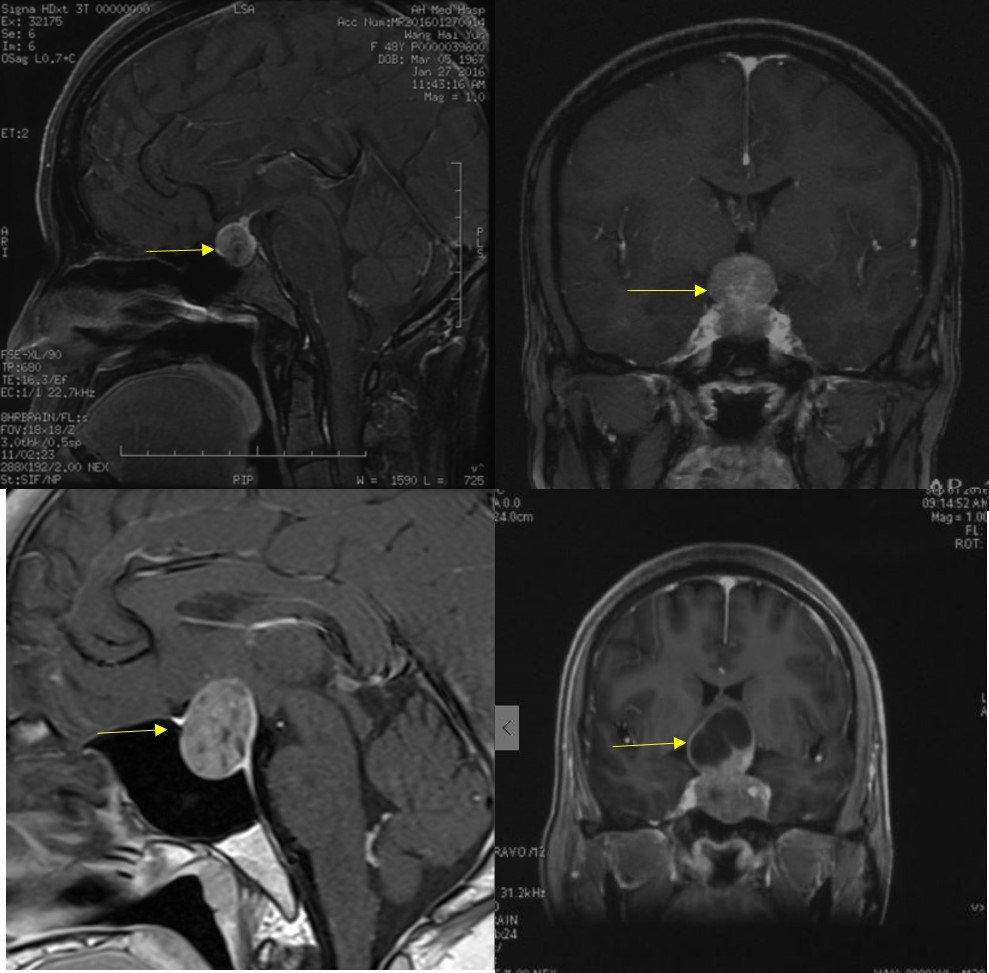 脑垂体瘤症状早期症状 脑垂体在哪个位置图片