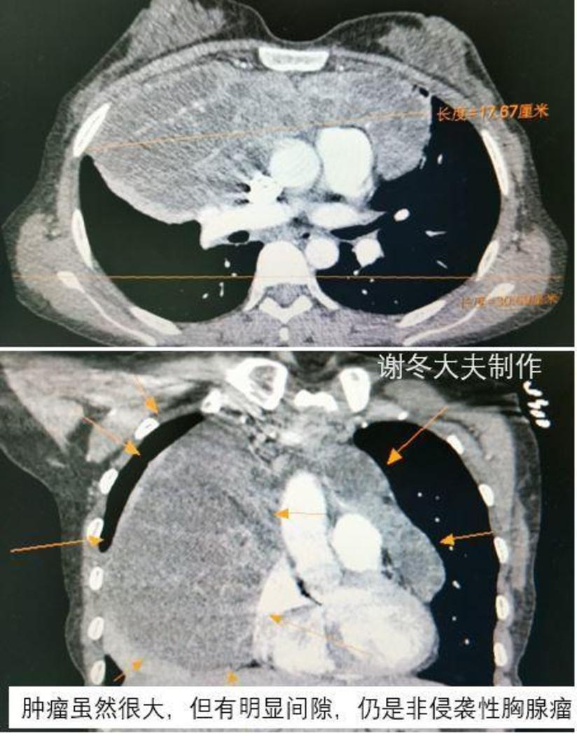 胸腺瘤 前纵隔占位 前纵隔结节 伴有肌无力是癌症吗 健康号 微医