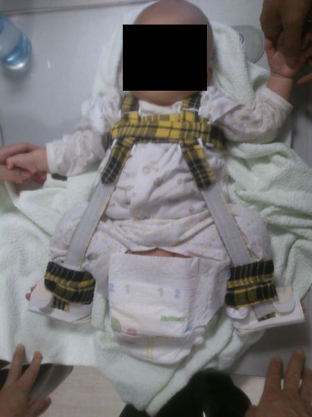 髋人字石膏外固定左髋脱位闭合复位 石膏外固定后复查x线4岁左侧髋