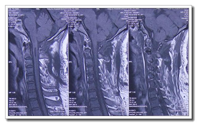 微创手术成功缓解小脑扁桃体下疝伴脊髓空洞症状