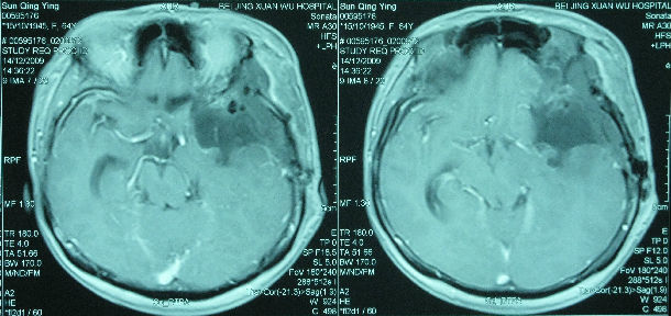 左侧蝶骨嵴巨大脑膜瘤切除根治