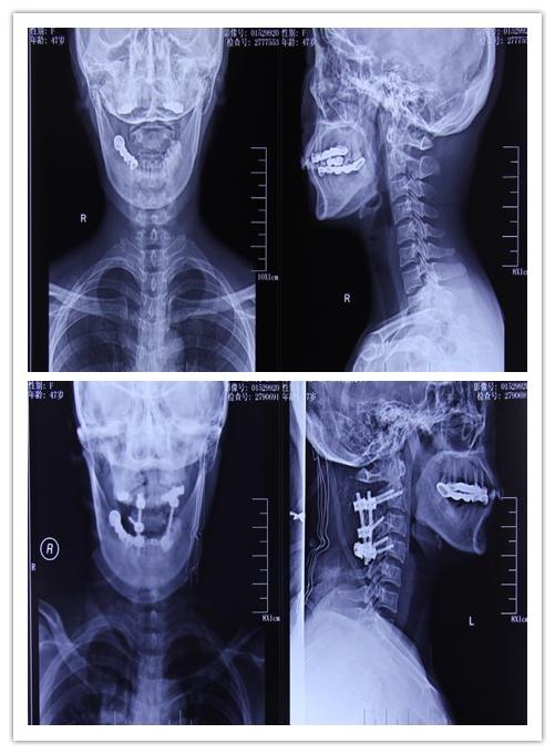 贺晓生教授:枕颈交界区多发神经鞘瘤