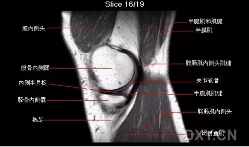 关节影像膝关节的磁共振mri解剖表现