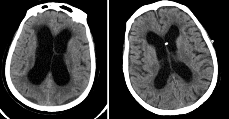 正常压力性脑积水性通常可以通过微创的手术来治疗,目前临床上最常