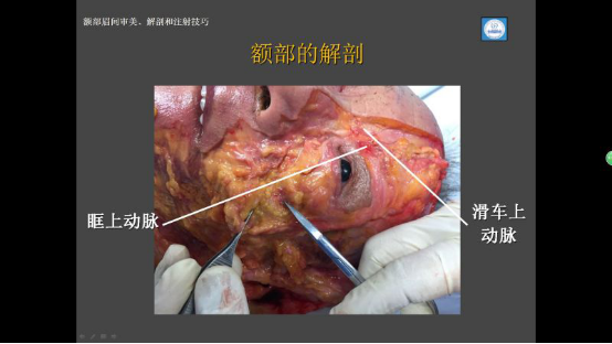 这张图片是额部横断面解剖,一个冠状切口,我们看到的是帽状腱膜和颞肌