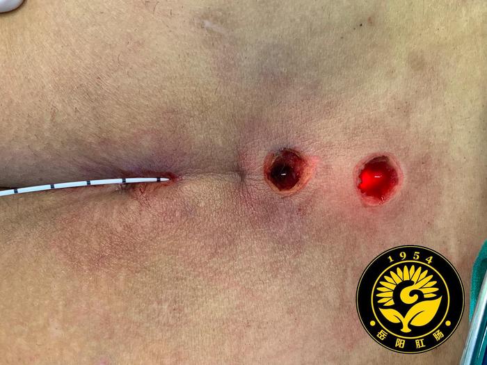 激光治疗藏毛窦病例分享_吴炯医生文章_上海中医药大学附属岳阳中西医