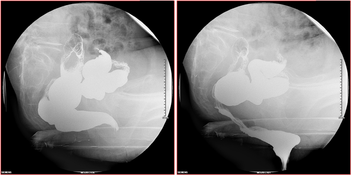 骶神经调节术教程(19)——排粪造影检查 - 微医(挂号网)