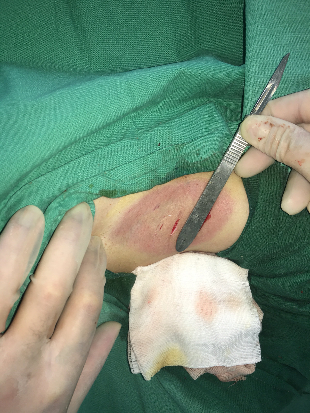 腋臭手术微紫的色泽刚刚好