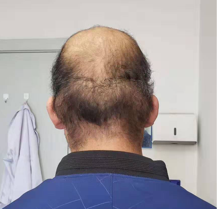 十年之后我不认得你帅小伙容貌巨变祸因小小的垂体瘤