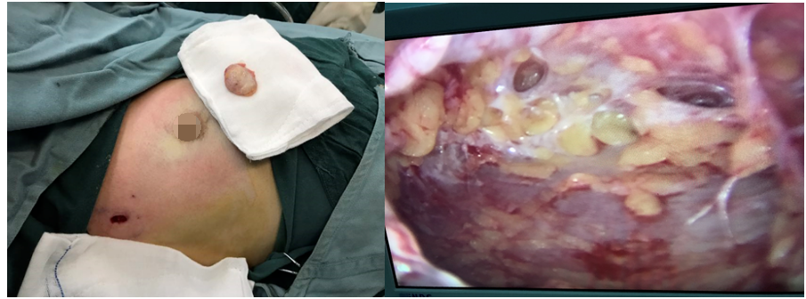 男性乳腺发育症如何选择正确的微创手术