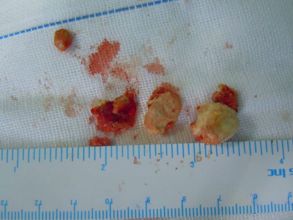 涎腺镜辅助微创下颌下腺涎石取出术有图片