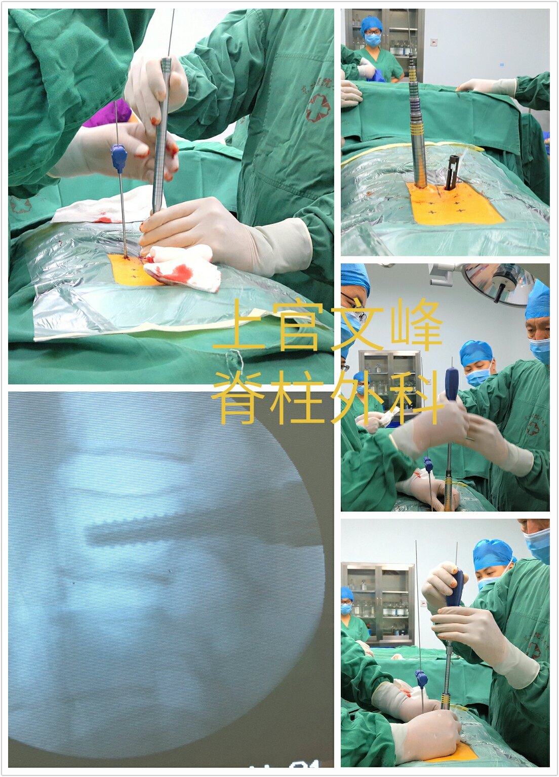 我省首例OLIF腰椎融合术在湘雅三医院脊柱外科成功开展 - 中南大学湘雅三医院