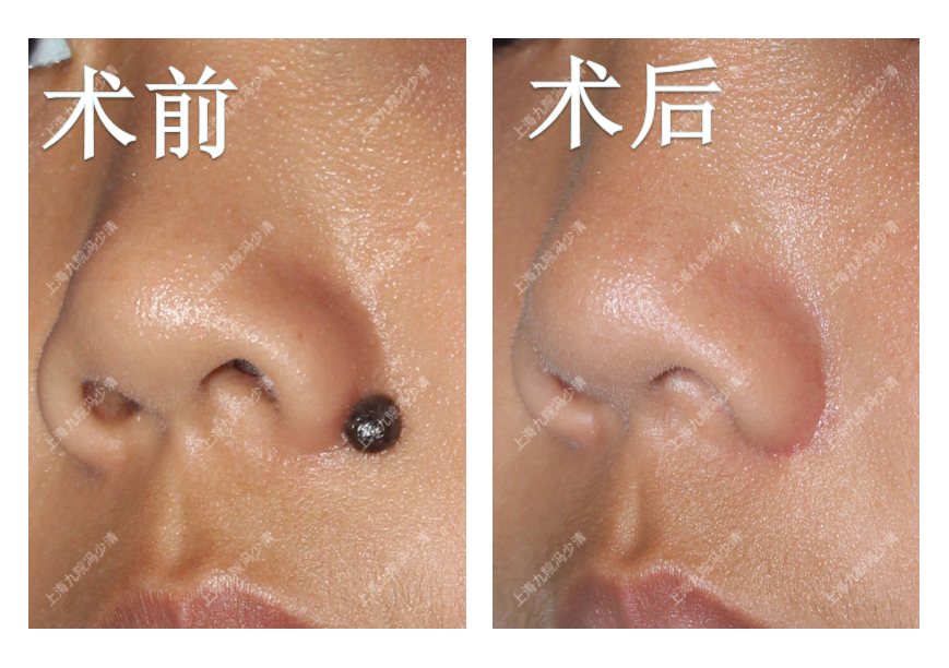 体表黑痣的手术治疗