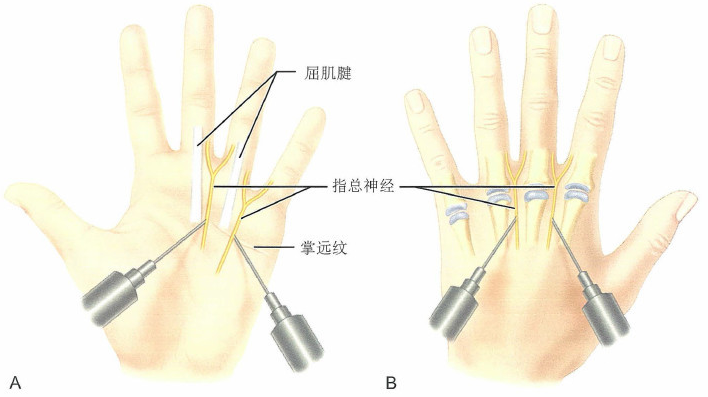 拔甲的麻醉示意图图片