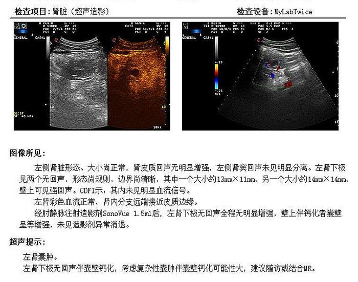 複雜性腎囊腫和囊性腎癌的鑑別診斷